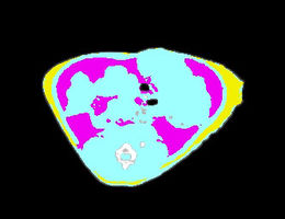 FLI: Fat distribution analysis