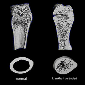 Mamorknochenkrankheit