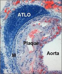 Arteriosklerose - Immunabwehr wird zum Gefäßkiller